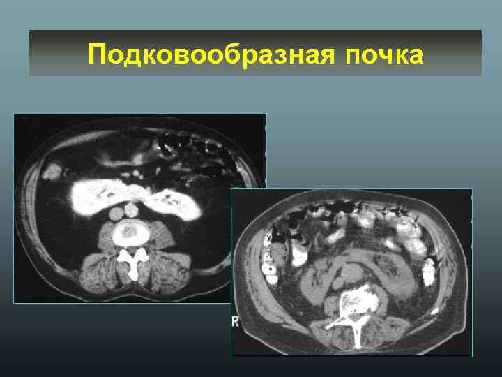 Подковообразная почка 