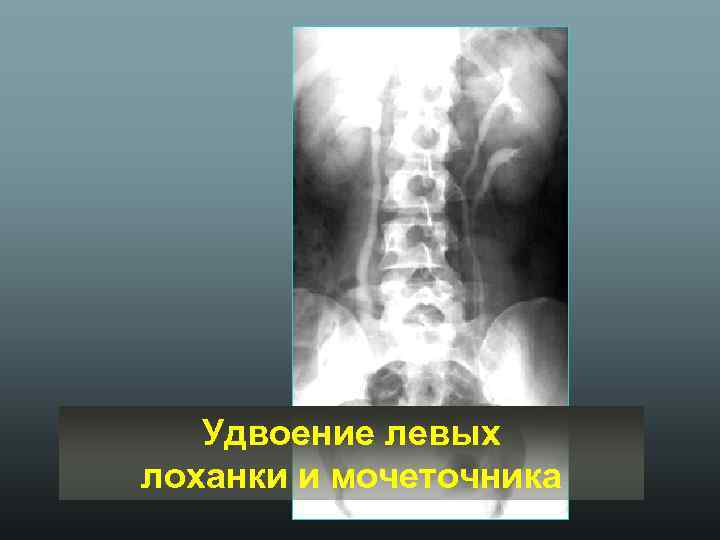 Удвоение левых лоханки и мочеточника 