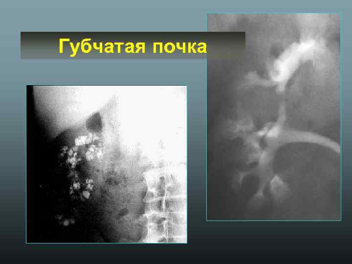 Губчатая почка 