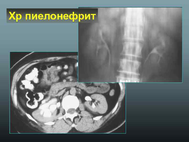 Хр пиелонефрит 