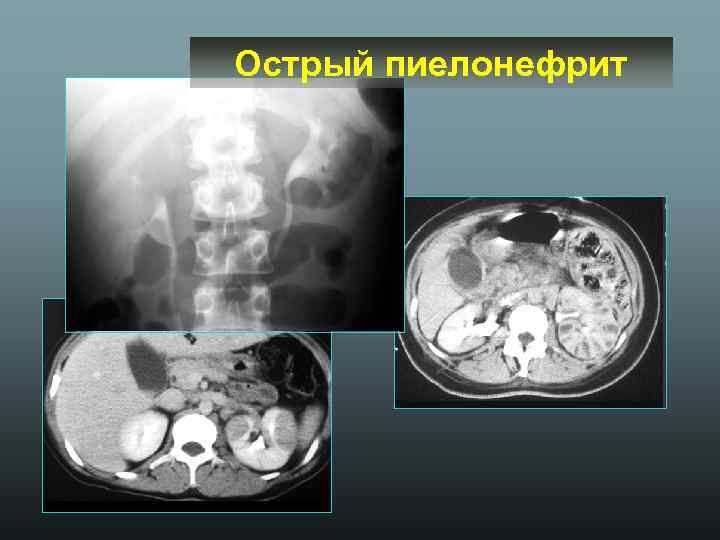 Острый пиелонефрит 