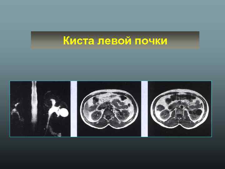Киста левой почки 