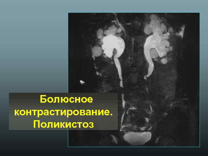 Болюсное контрастирование. Поликистоз 