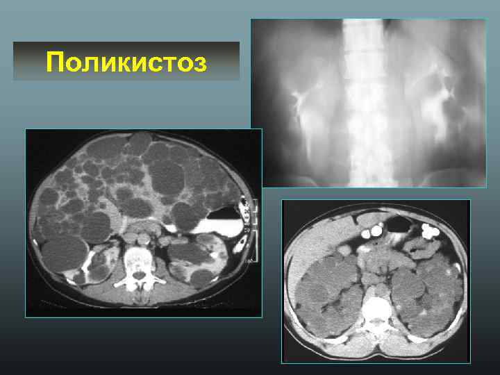 Поликистоз 