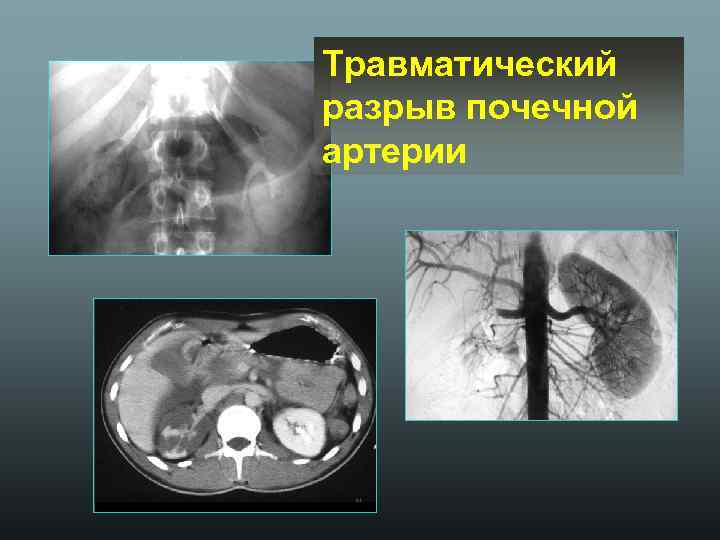 Травматический разрыв почечной артерии 