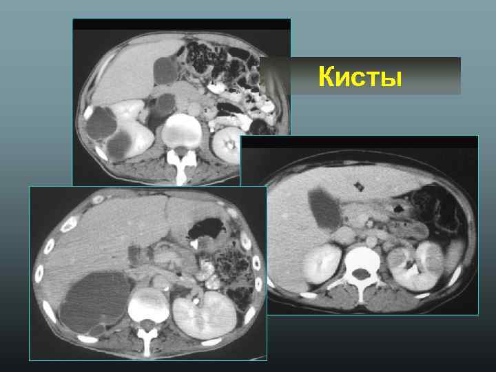 Кисты 