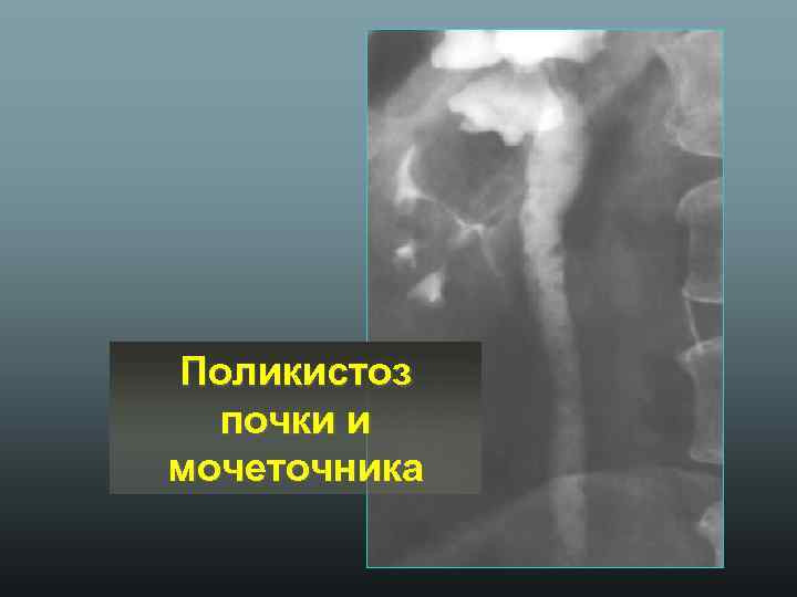Поликистоз почки и мочеточника 