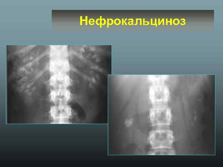 Нефрокальциноз 