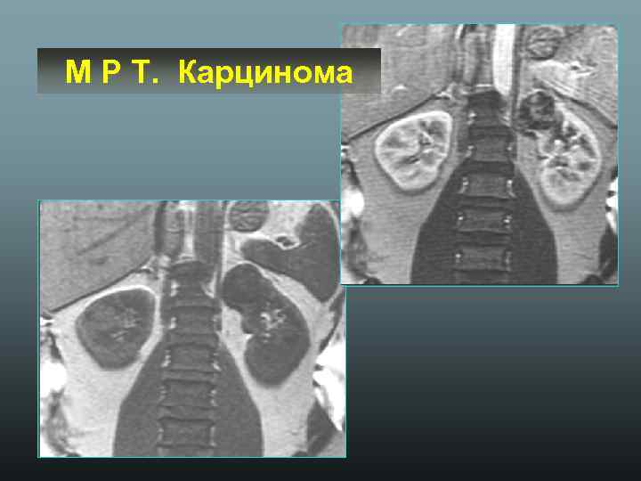 М Р Т. Карцинома 