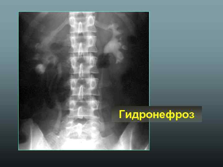 Гидронефроз 