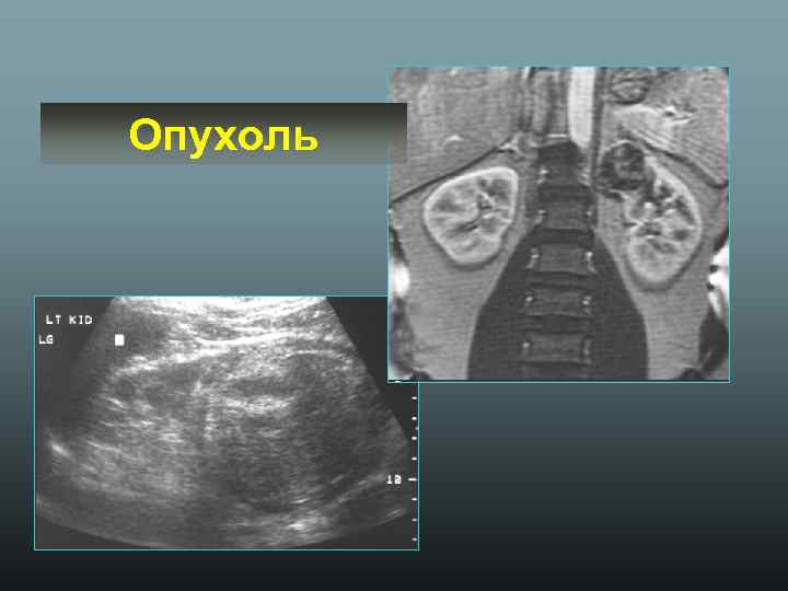 Опухоль 