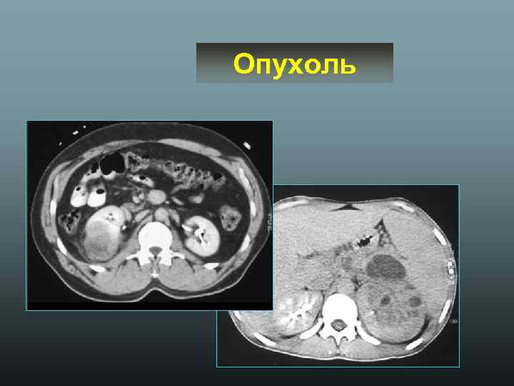Опухоль 