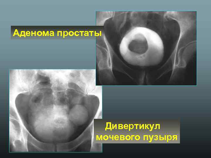 Аденома простаты Дивертикул мочевого пузыря 