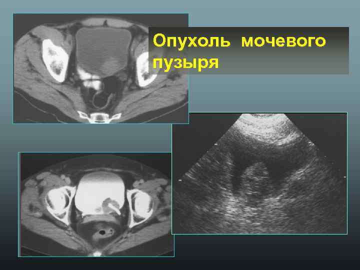 Опухоль мочевого пузыря 