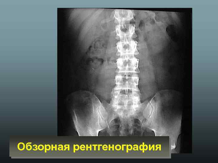 Обзорная рентгенография 