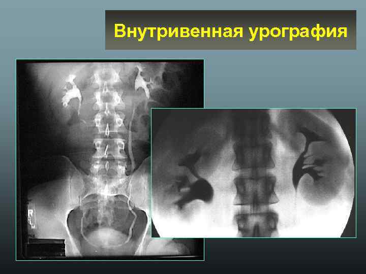 Внутривенная урография 