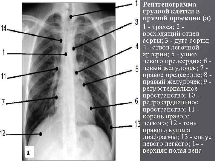  Рентгенограмма грудной клетки в прямой проекции (а) 1 - трахея; 2 восходящий отдел