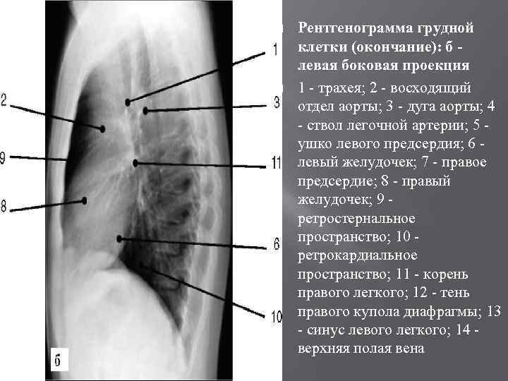  Рентгенограмма грудной клетки (окончание): б левая боковая проекция 1 - трахея; 2 -