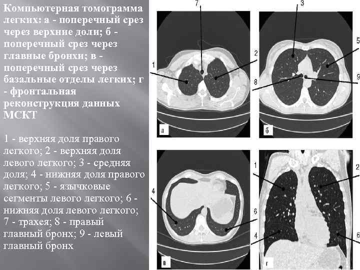 Компьютерная томограмма легких: а - поперечный срез через верхние доли; б поперечный срез через