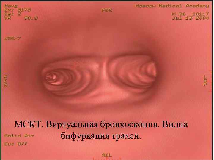 МСКТ. Виртуальная бронхоскопия. Видна бифуркация трахеи. 