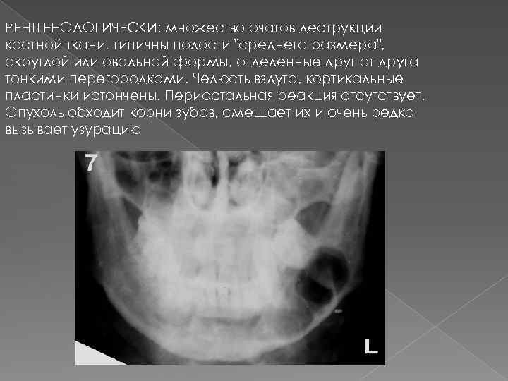 Деструкция костной ткани