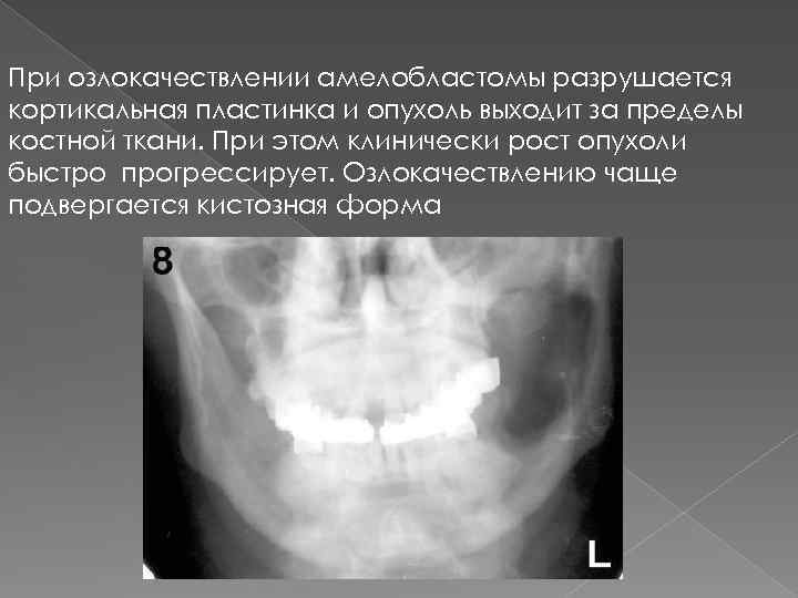 Рентгенологическая картина амелобластомы характеризуется