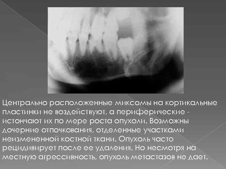 Центрально расположенные миксомы на кортикальные пластинки не воздействуют, а периферические истончают их по мере