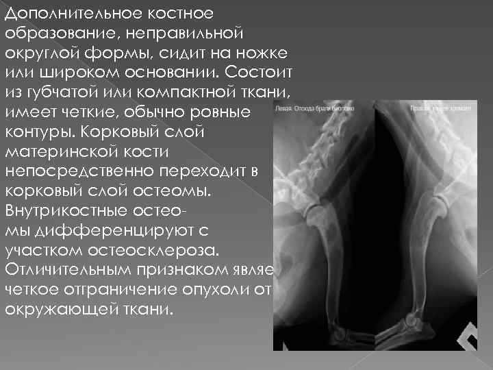 Дополнительное костное образование, неправильной округлой формы, сидит на ножке или широком основании. Состоит из