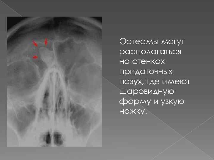 Остеомы могут располагаться на стенках придаточных пазух, где имеют шаровидную форму и узкую ножку.