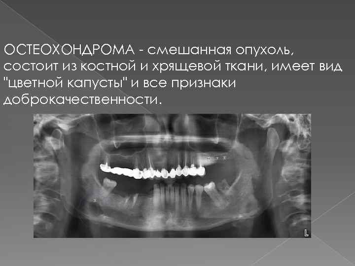 ОСТЕОХОНДРОМА - смешанная опухоль, состоит из костной и хрящевой ткани, имеет вид "цветной капусты"