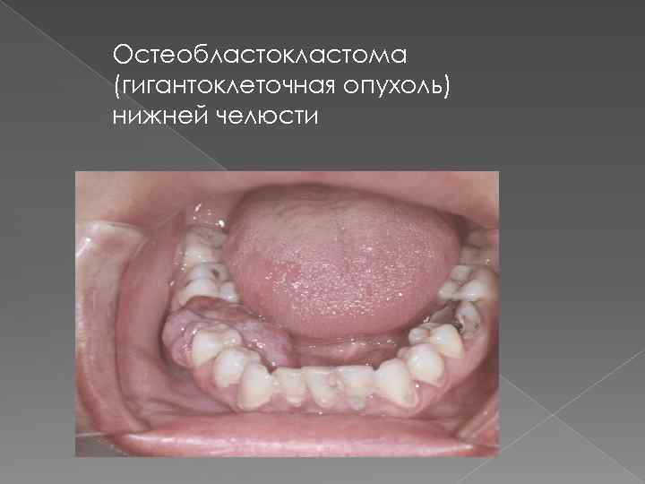 Остеобластокластома (гигантоклеточная опухоль) нижней челюсти 