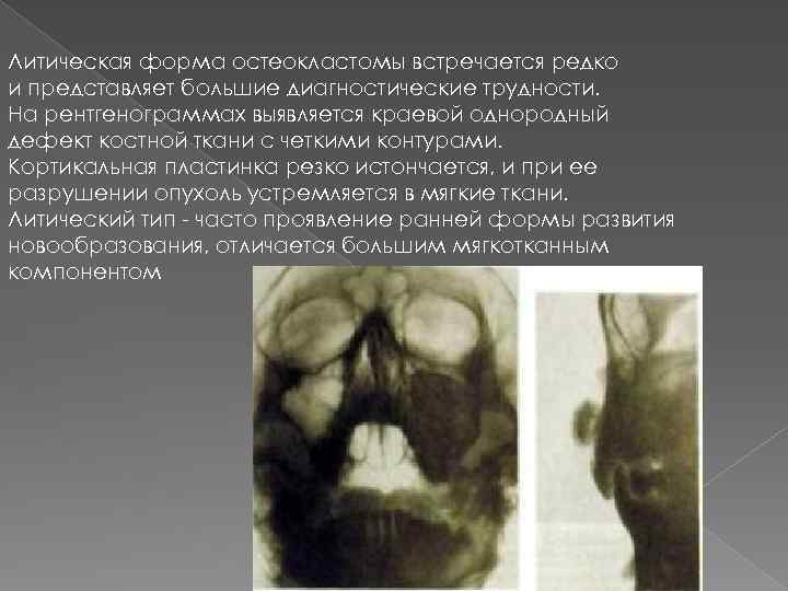 Литическая форма остеокластомы встречается редко и представляет большие диагностические трудности. На рентгенограммах выявляется краевой