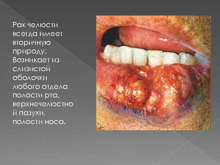 Рак челюсти всегда имеет вторичную природу. Возникает из слизистой оболочки любого отдела полости рта,