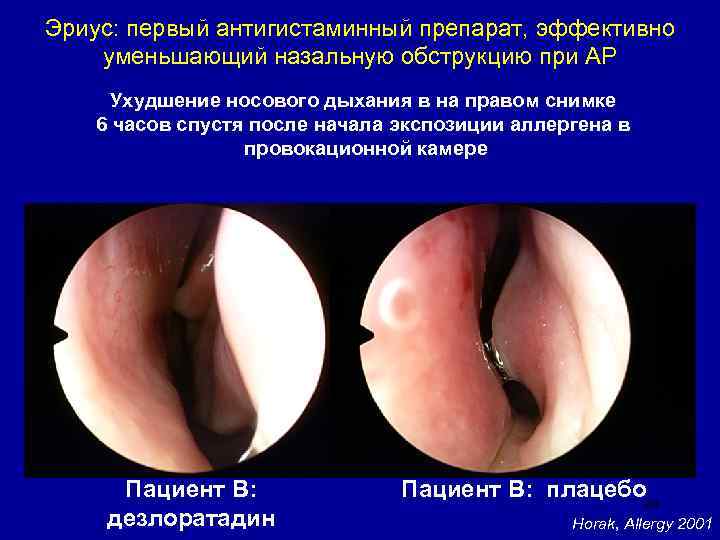 Эриус: первый антигистаминный препарат, эффективно уменьшающий назальную обструкцию при АР Ухудшение носового дыхания в