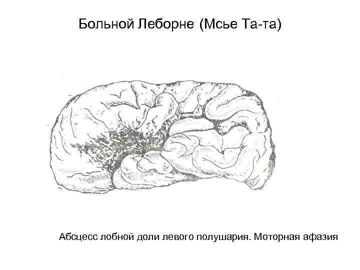 Больной Леборне (Мсье Та-та) Абсцесс лобной доли левого полушария. Моторная афазия 