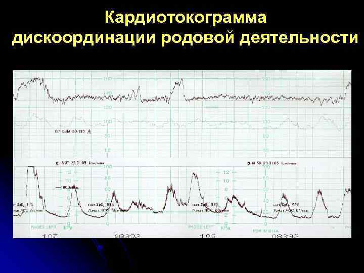 Кардиотокограмма дискоординации родовой деятельности 