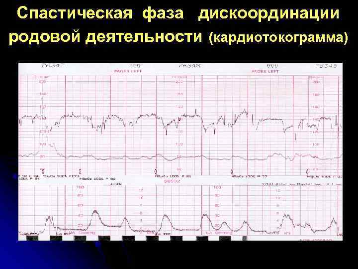 Спастическая фаза дискоординации родовой деятельности (кардиотокограмма) 