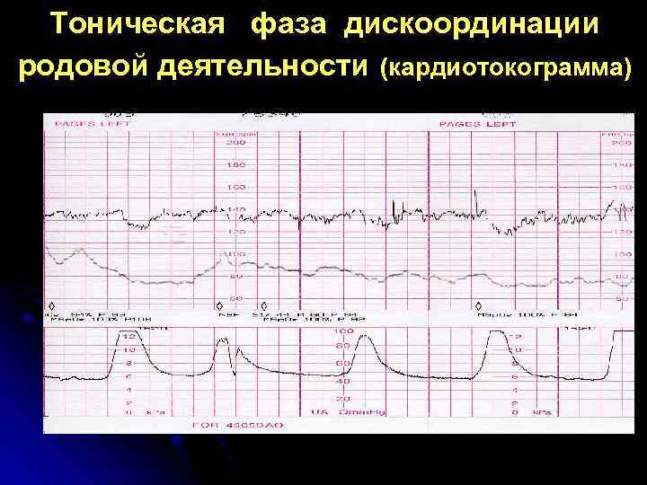 Тоническая фаза дискоординации родовой деятельности (кардиотокограмма) 