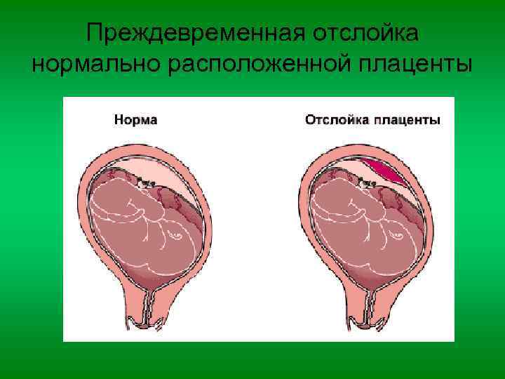 Преждевременная отслойка нормально расположенной плаценты 