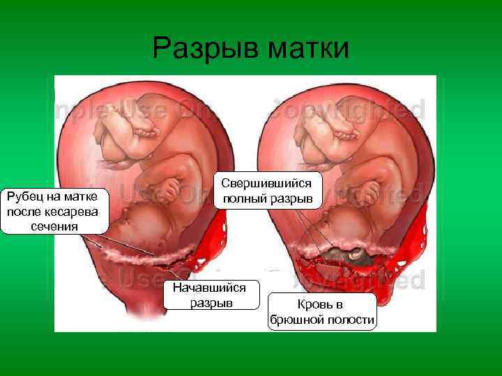 Разрыв матки Рубец на матке после кесарева сечения Свершившийся полный разрыв Начавшийся разрыв Кровь