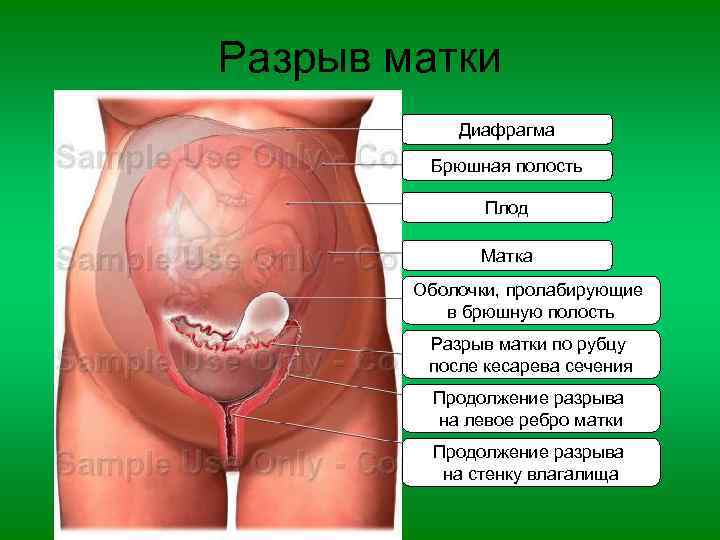 Разрыв матки Диафрагма Брюшная полость Плод Матка Оболочки, пролабирующие в брюшную полость Разрыв матки