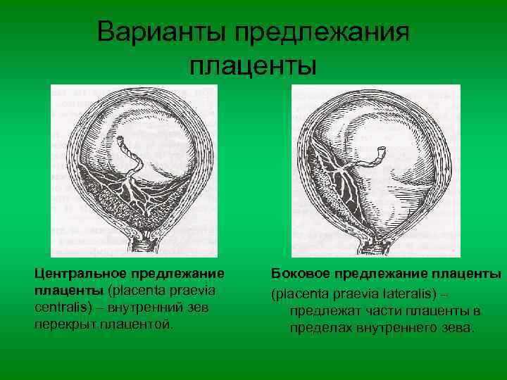 Варианты предлежания плаценты Центральное предлежание плаценты (placenta praevia centralis) – внутренний зев перекрыт плацентой.