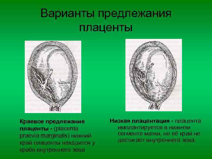 Варианты предлежания плаценты Краевое предлежание плаценты - (placenta praevia marginalis) нижний край плаценты находится