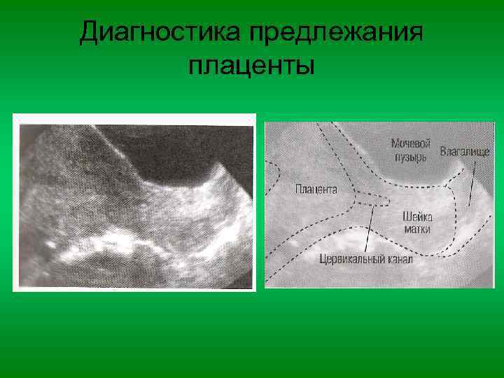 Диагностика предлежания плаценты 