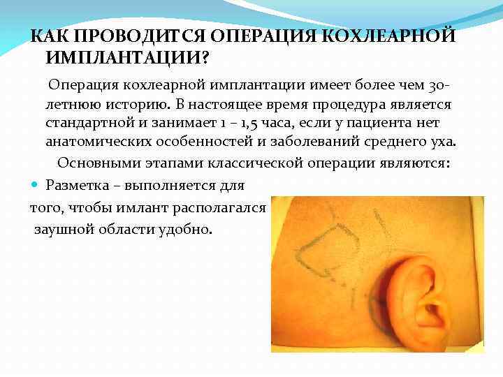 КАК ПРОВОДИТСЯ ОПЕРАЦИЯ КОХЛЕАРНОЙ ИМПЛАНТАЦИИ? Операция кохлеарной имплантации имеет более чем 30 летнюю историю.
