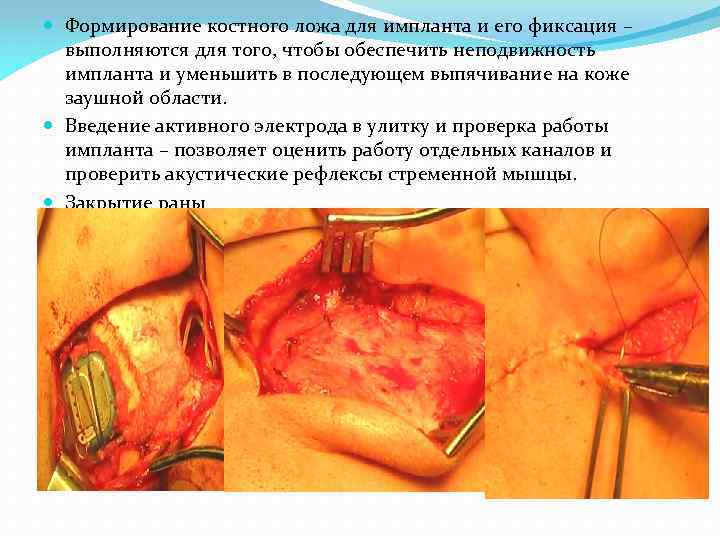  Формирование костного ложа для импланта и его фиксация – выполняются для того, чтобы