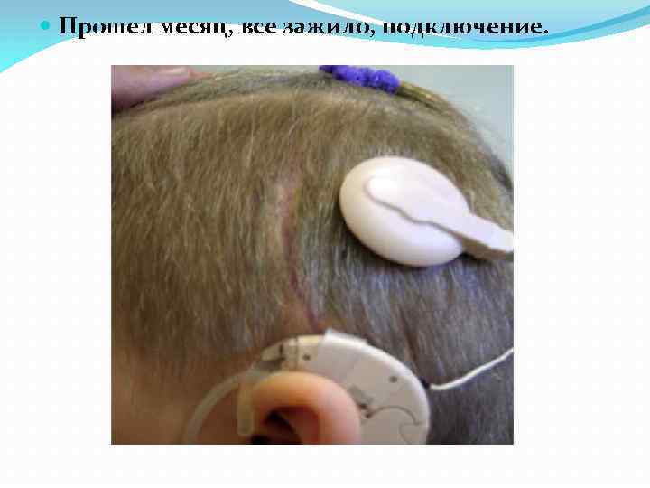  Прошел месяц, все зажило, подключение. 