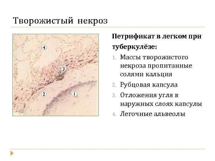 Творожистый некроз 4 3 2 1 Петрификат в легком при туберкулёзе: 1. Массы творожистого