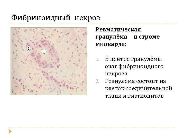 Фибриноидный некроз 2 Ревматическая гранулёма в строме миокарда: 1 1. 2. В центре гранулёмы