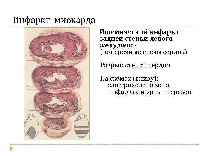 Инфаркт миокарда Ишемический инфаркт задней стенки левого желудочка (поперечные срезы сердца) Разрыв стенки сердца